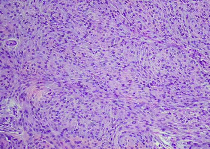 Meningioma cells dyed purple 