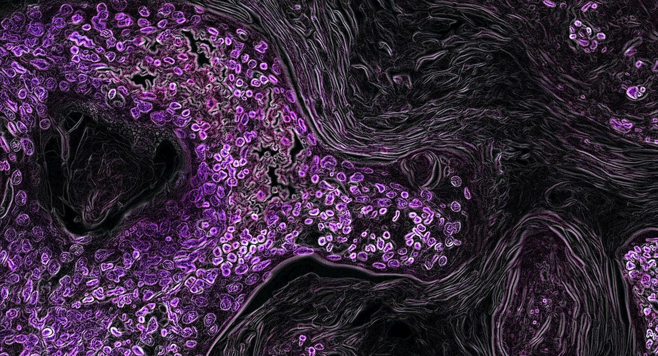 A microscopic image of lung cancer cells stained purple