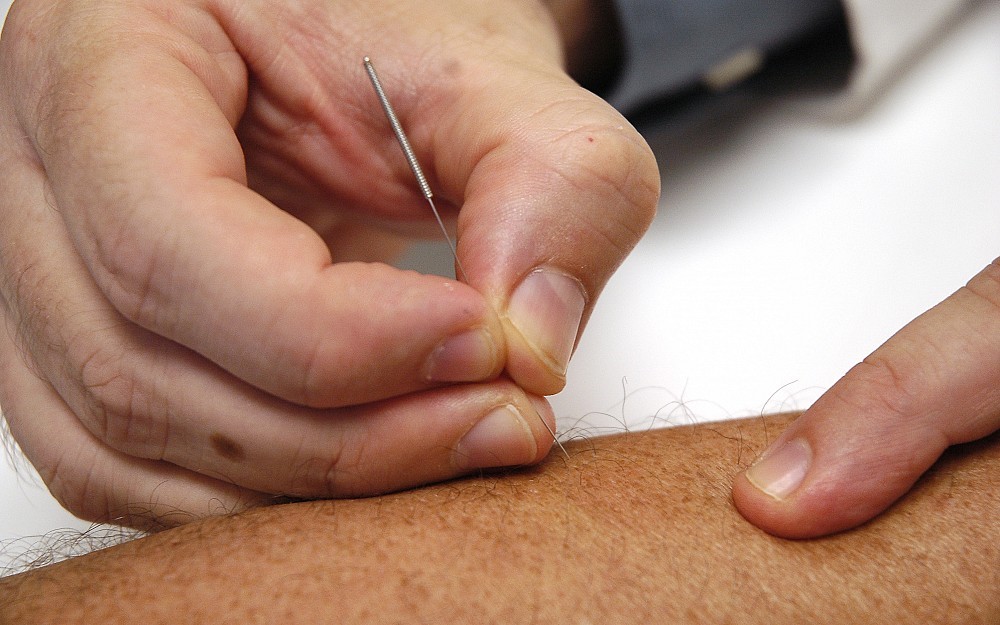 
Acupuncture techniques vary, but more modern practice involves placing tiny stainless steel needles into points on the body.