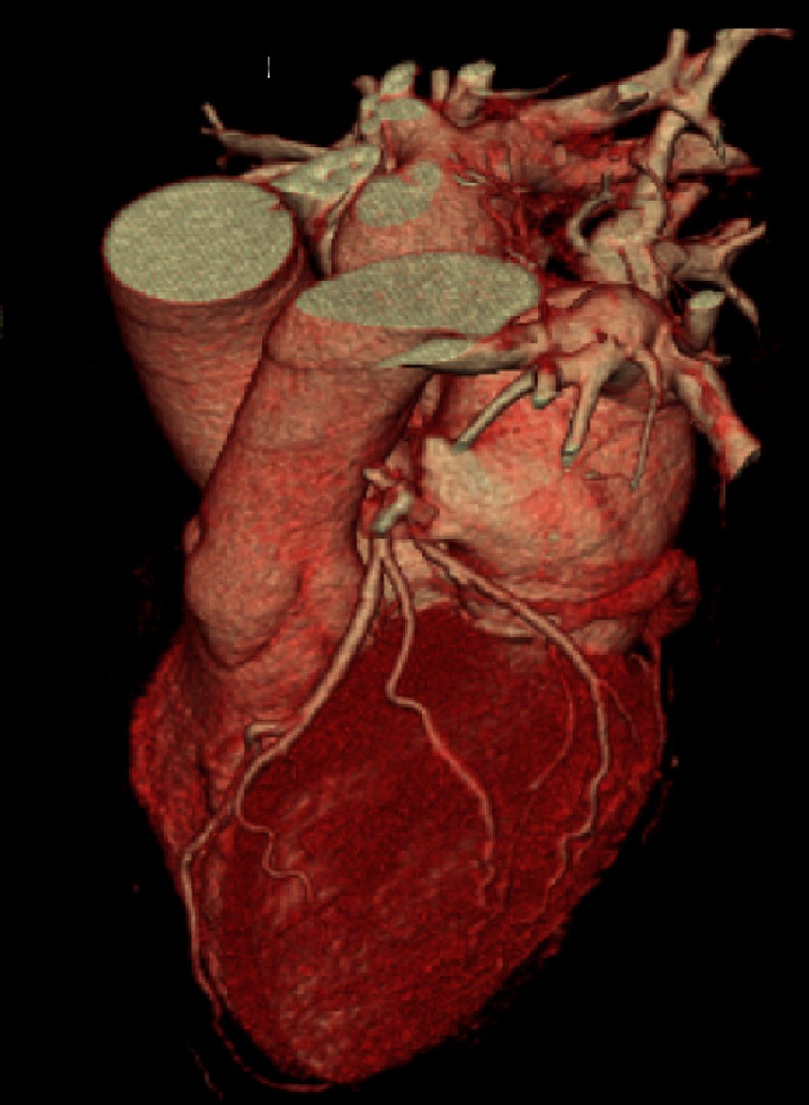 A new state-of-the art scanner called the 64-slice CT (computerized tomography) allows physicians to gather detailed high-resolution images of the heart and coronary arteries to help diagnose disease. 