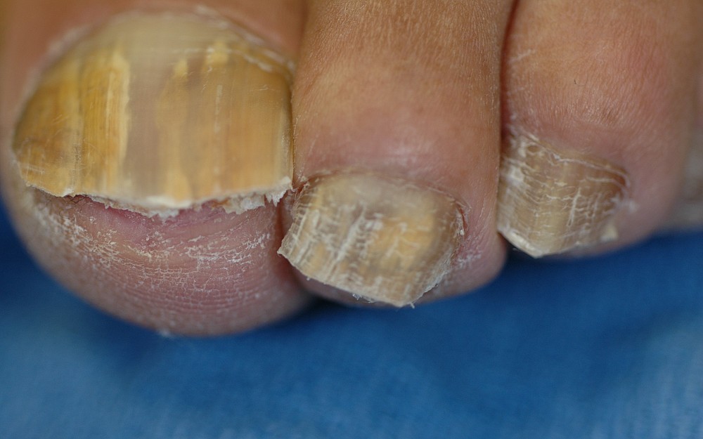Toenail fungus infections can be painful and diffcult to treat. 