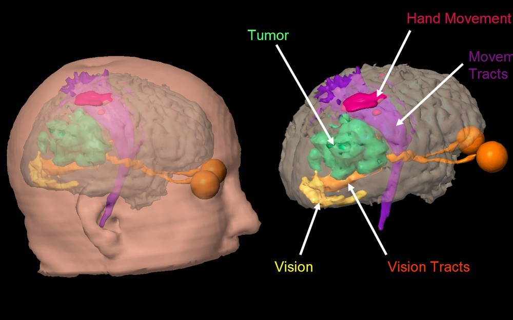 Functional MRI helps neuroradiologists identify important areas of brain function.