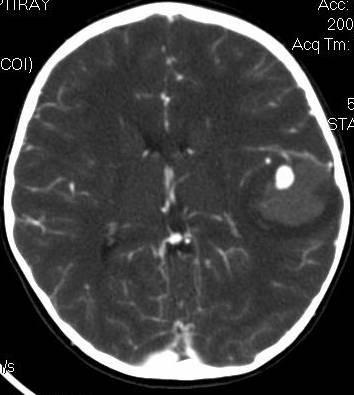 This shows a middle arterial intracranial aneurysm (large white spot on right) in a pediatric patient. The light gray area around the aneurysm represents bleeding. 