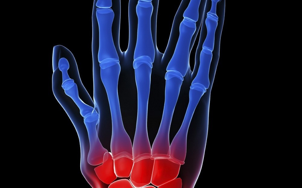 an arthritic hand with swelling of the joints