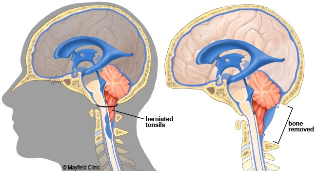 Chiari malformation, before (left) and after surgery (right), with enlarged cerebrospinal fluid space. 