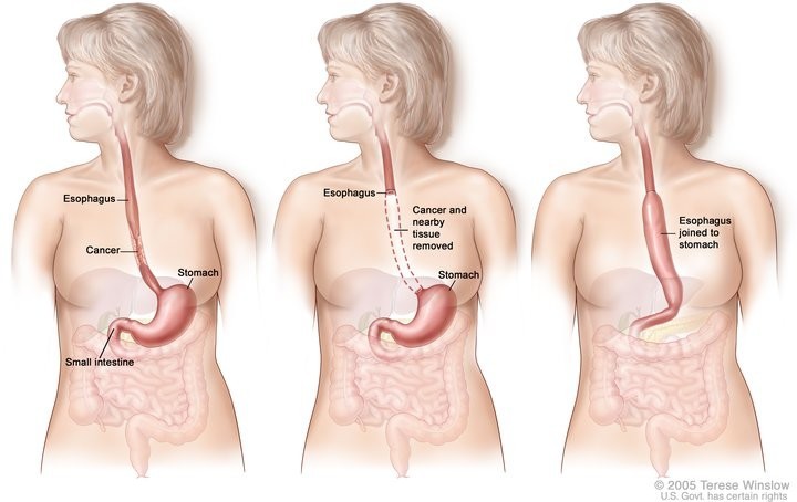 Three-panel drawing showing esophageal cancer surgery (National Cancer Institute) 