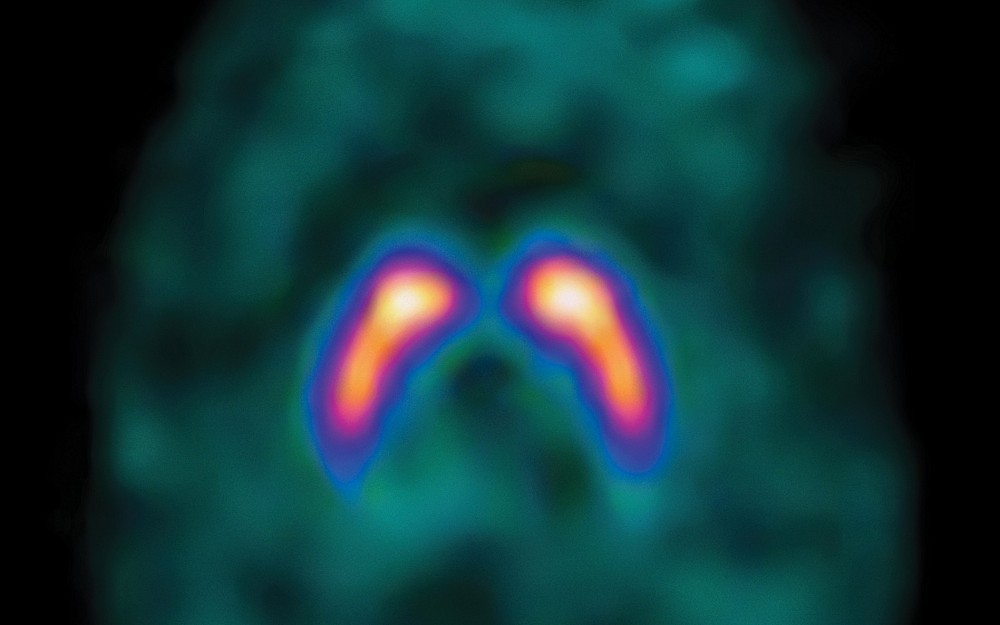 A DaTscan image, showing normal dopamine activity in the brain. Nira Ben-Jonathan has found that a receptor in dopamine is linked to breast cancer. 